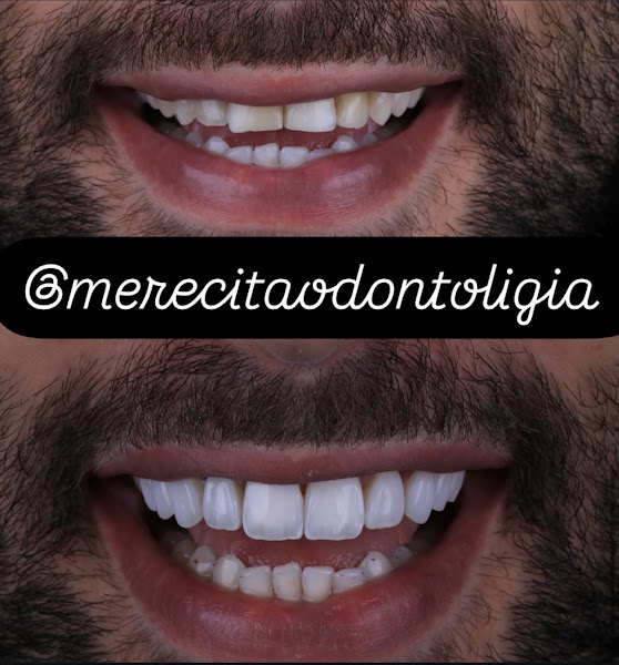 Foto 2 de Merecitá Odontologia IMPLANTES DENTÁRIOS
