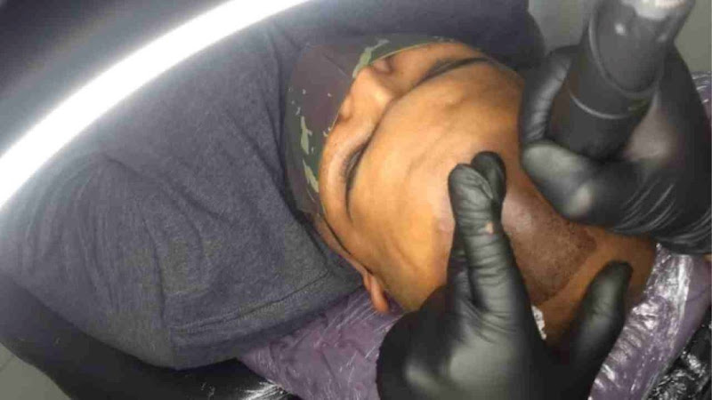 Foto 2 de Micropigmentação Capilar em Santos-SP - Clínica Tiago Nunes