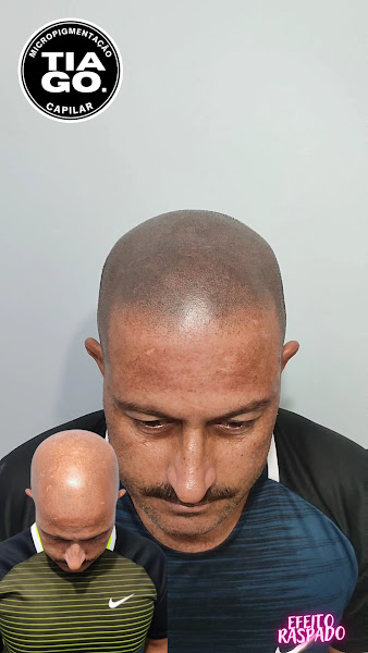 Foto 3 de Micropigmentação Capilar em Santos-SP - Clínica Tiago Nunes