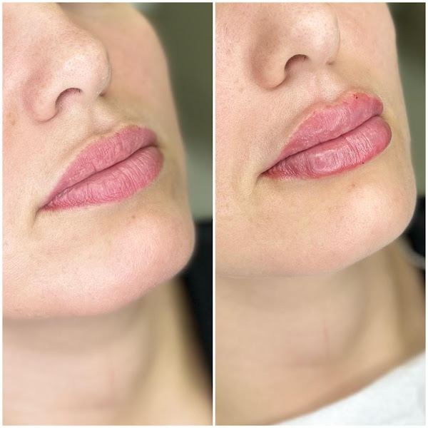 Foto 3 de MOLDAFACE Harmonização Facial