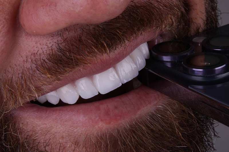 Foto 3 de Nara Clinic | lentes em resina em Tatuapé São Paulo | Implantes dentários em Tatuapé São Paulo