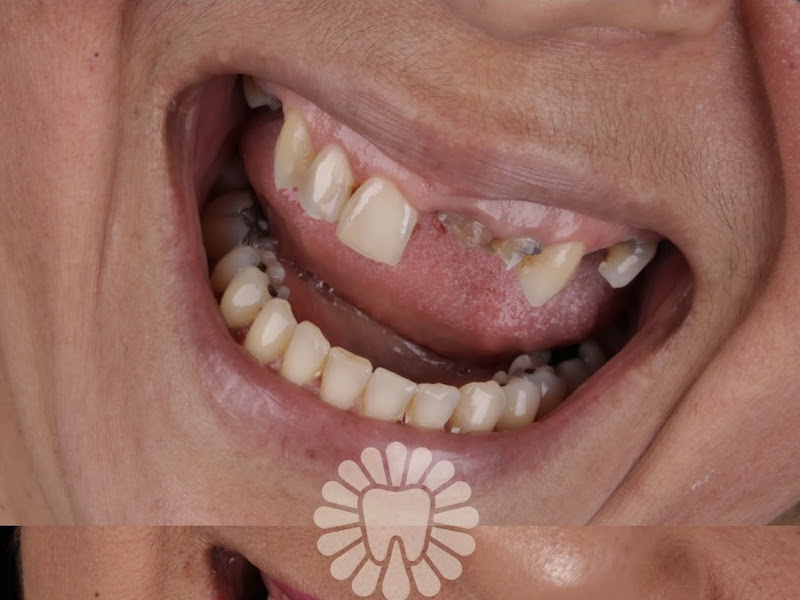 Foto 6 de Nara Clinic | lentes em resina em Tatuapé São Paulo | Implantes dentários em Tatuapé São Paulo