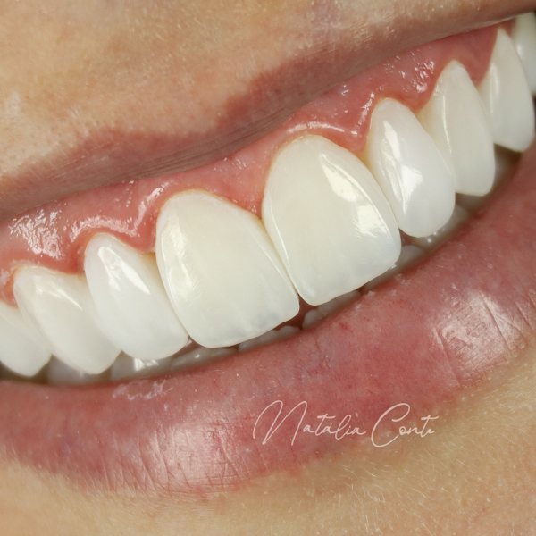 Foto 2 de Natália Conte Odontologia | Lentes e facetas em resina Ribeirão Preto