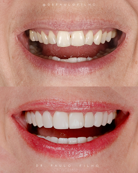 Foto 2 de Neto & Filho Odontologia Especializada - Lentes e Facetas em Resina - Implantes Dentários