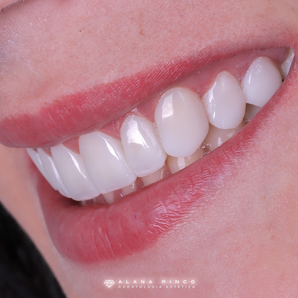 Foto 2 de Nice Odonto Barbacena Facetas Lentes Implantes