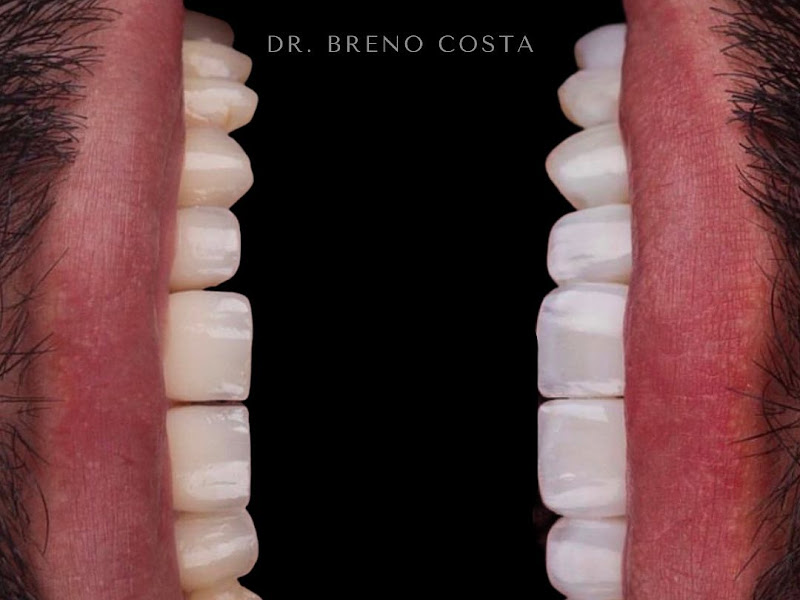 Foto 2 de NIO Prime - Facetas em Resina