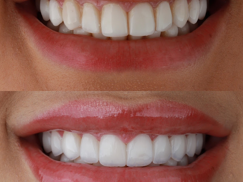 Foto 3 de Nive Odontologia | Lentes de Contato Dental