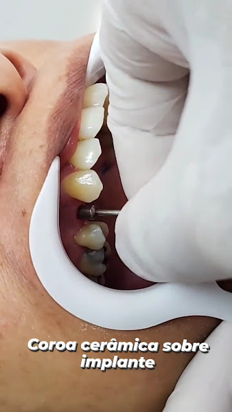 Foto 3 de Nora Odontologia - Dr. Rafael Nora - Implante - Dentista