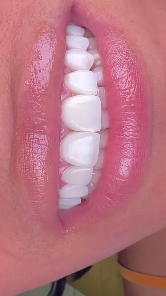 Foto 4 de NP Clínica Odontológica | Dentista Asa Norte | Invisalign Lentes Resina Composta Asa Norte