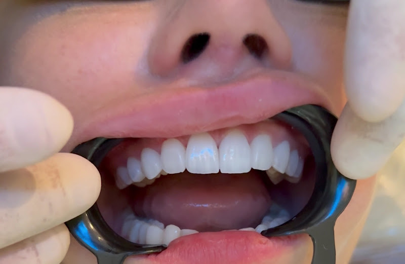 Foto 4 de Odonto Armoni I Especialista em Lentes de Contato Dental | Implantes | Ortodôntia