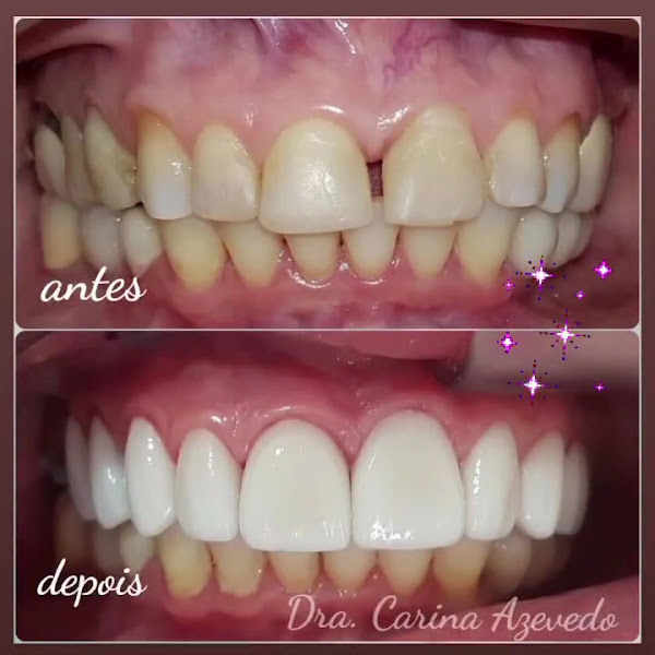 Foto 4 de Odonto Estética e Prótese - Próteses, Implantes e Facetas em Porto Velho