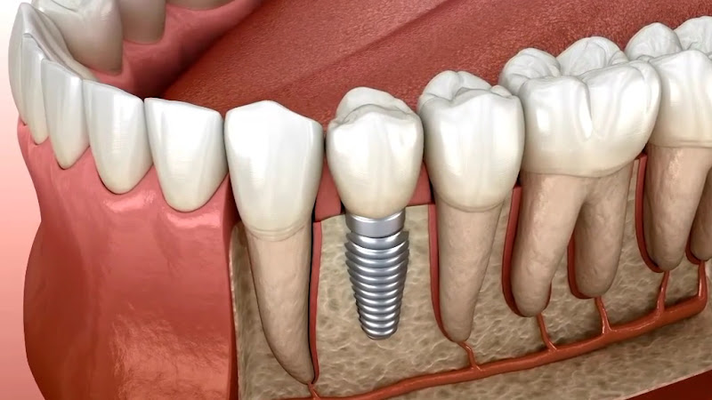 Foto 3 de Odonto Figueiredo 🦷🇧🇷 🇪🇸 Dentista em Santana , São Paulo | Prótese | Implantes | Clareamento | Facetas e outros serviços.