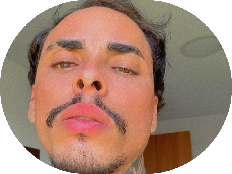 Foto 6 de Odonto & Mais | Lipo de Papada | Preenchimento Labial | Freguesia (Jacarepaguá) - RJ