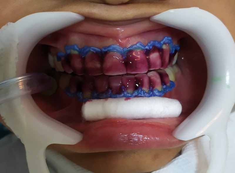 Foto 2 de Odonto Pitangueiras dentista matatu