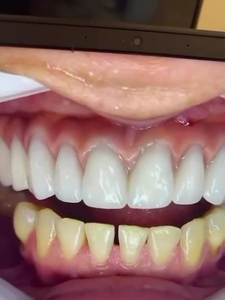 Foto 3 de OdontoBetha Ipatinga/ Implantes/ Facetas/ Próteses