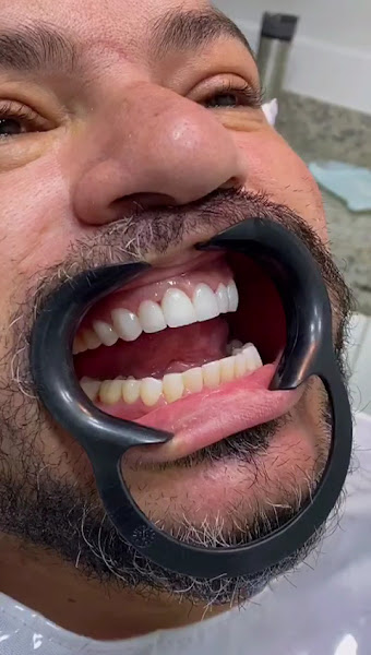 Foto 4 de OdontoBetha Ipatinga/ Implantes/ Facetas/ Próteses