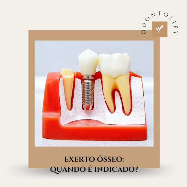 Foto 3 de Odontolift | Dentista em Brusque | Lentes em resina | Ortodontia | Harmonização Facial | Dra. Fernanda Luchi