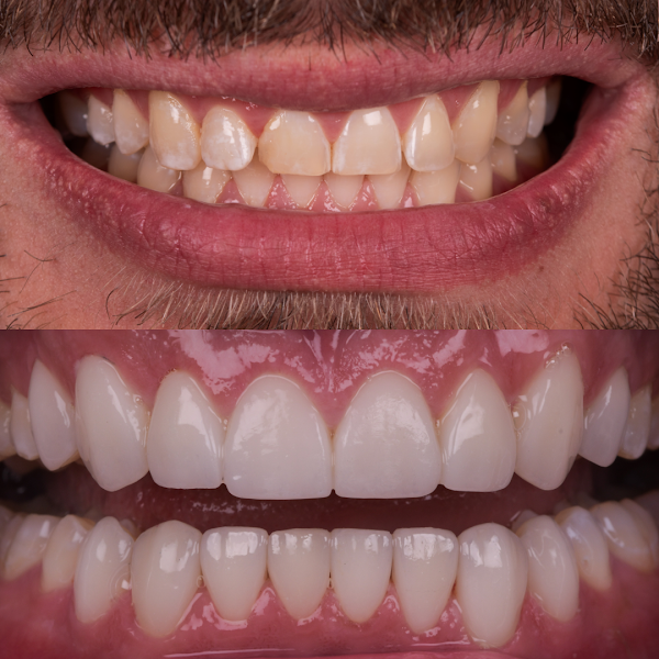 Foto 2 de Odontoliuzzi - La Prime - Lentes de Contato Dentais l Facetas de Porcelana l Veneers l All on 6 - Dentist for Foreigners