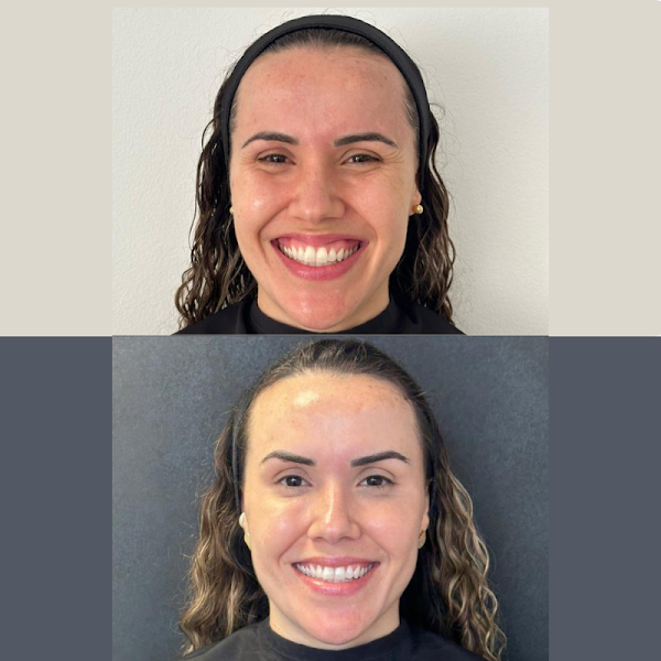 Foto 3 de Odontologia Avançada & Harmonização Orofacial | Dra. Laise Barboza