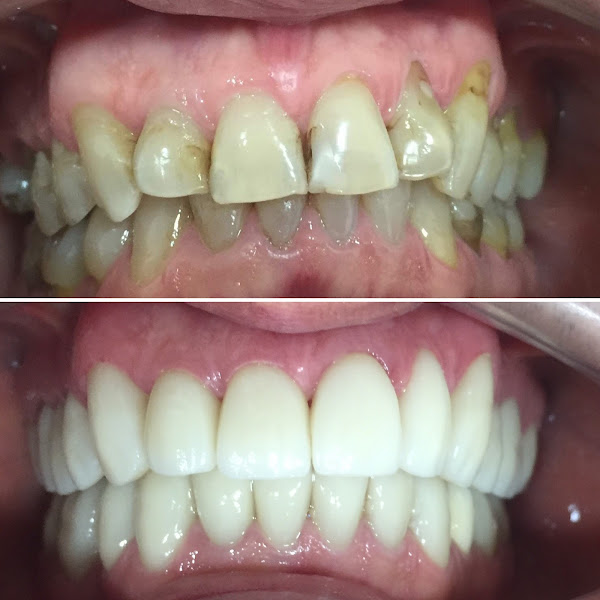 Foto 3 de Odontologia Dr Mauricio Bosquiero Implantodontista, Reabilitação Oral