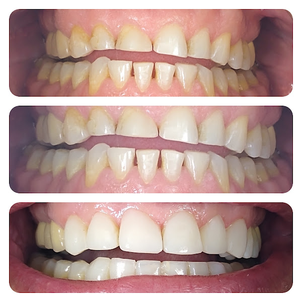 Foto 2 de Odontologia Dr. Tarcísio Cunha | Jaboatão dos Guararapes | Prótese | Implantes