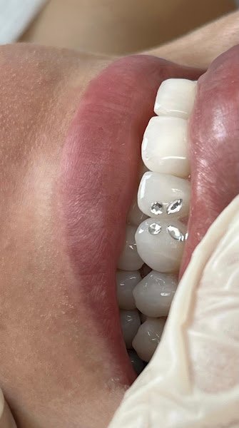 Foto 3 de Odontologia Dra. Jéssica de Carvalho - Facetas em resina | Preenchimento labial | Botox | Clareamento Dental |Piercing Dental