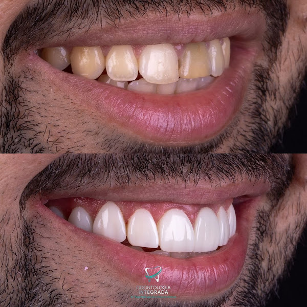 Foto 4 de Odontologia Integrada Natal | Implante sem corte, sem dor e resultado imediato | Dentista em Natal/RN