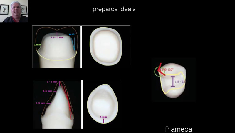 Foto de odontologia rapida com CAD/CAM em Americana SP CROSP 32141