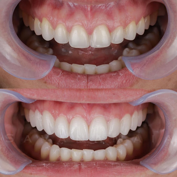 Foto 2 de Odontologia Savana Maia - Lente de Contato Dental - Invisalign - implante dentário