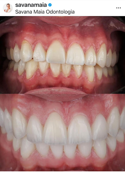 Foto 3 de Odontologia Savana Maia - Lente de Contato Dental - Invisalign - implante dentário