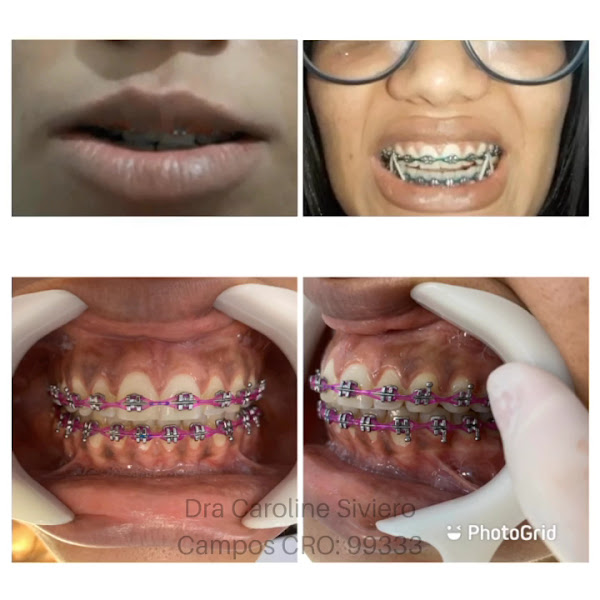 Foto 3 de Odontologia Siviero - Lente de contato dental - Santo André