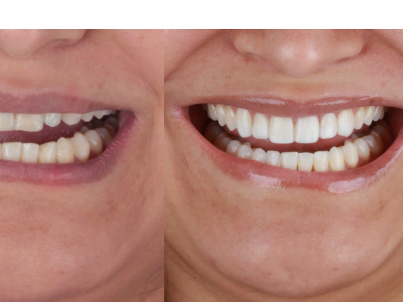 Foto 10 de ODONTOMAX - Nathália Duarte (CRO-40548) - Implante, Aparelho, Clareamento, Prótese