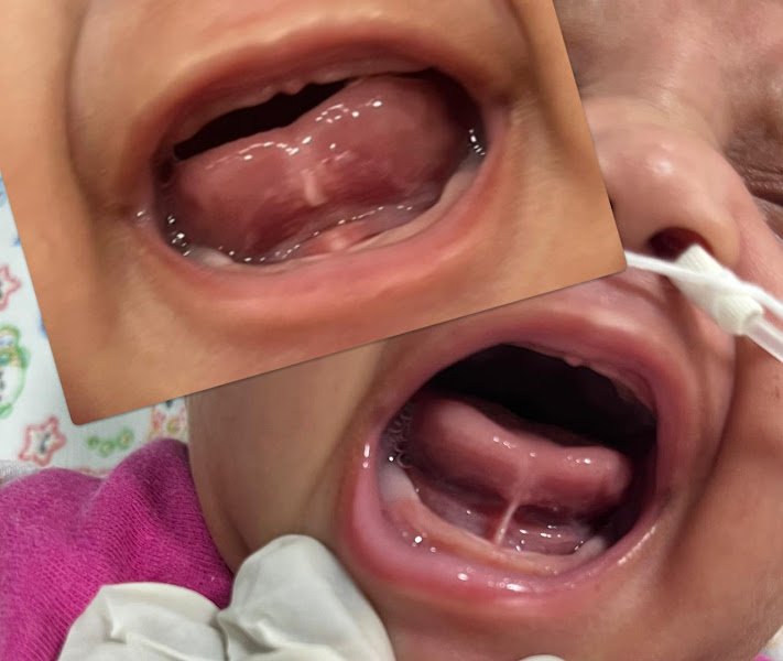 Foto 3 de ODONTOMINARDI | CIRURGIAS ORAIS | FRENECTOMIA