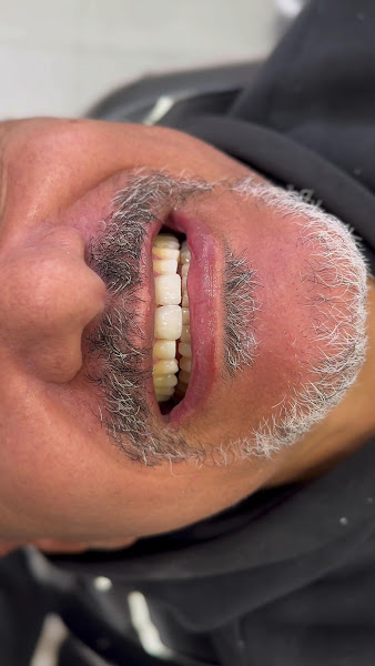 Foto 4 de Odontonobre Ipatinga | Prótese, Restauração, Canal, Faceta em Resina