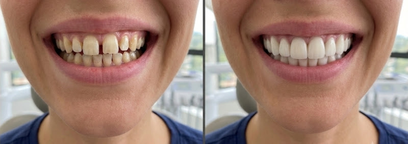 Foto 3 de Oli Dentista [Vila Helena] – Implantes, próteses, canal e muito mais