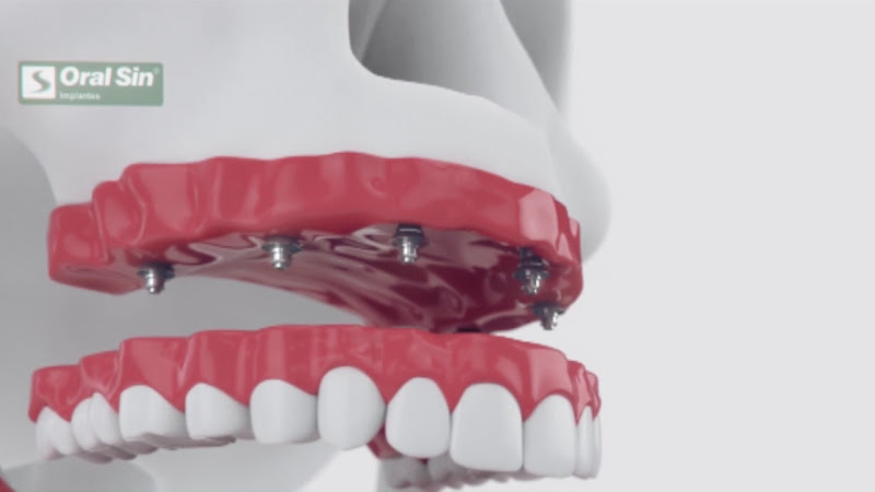 Foto 3 de Oral Sin Implantes Araraquara