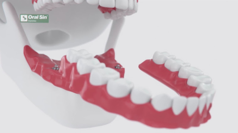 Foto 4 de Oral Sin Implantes Araraquara