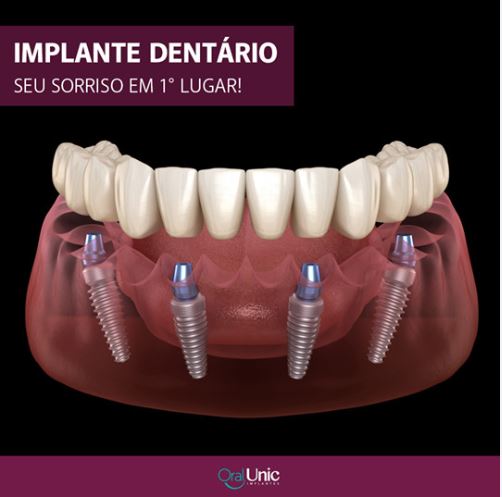 Foto 4 de Oral Unic Implantes Salvador