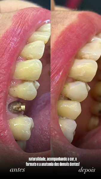 Foto 4 de Oralfy Teresina - Implantes • Facetas • Invisalign • Próteses