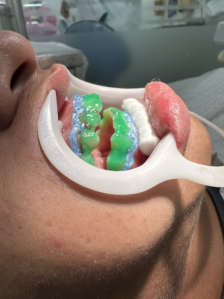 Foto 2 de Ortodontista Dr. Sinval Junior - Ortodontia - Invisalign