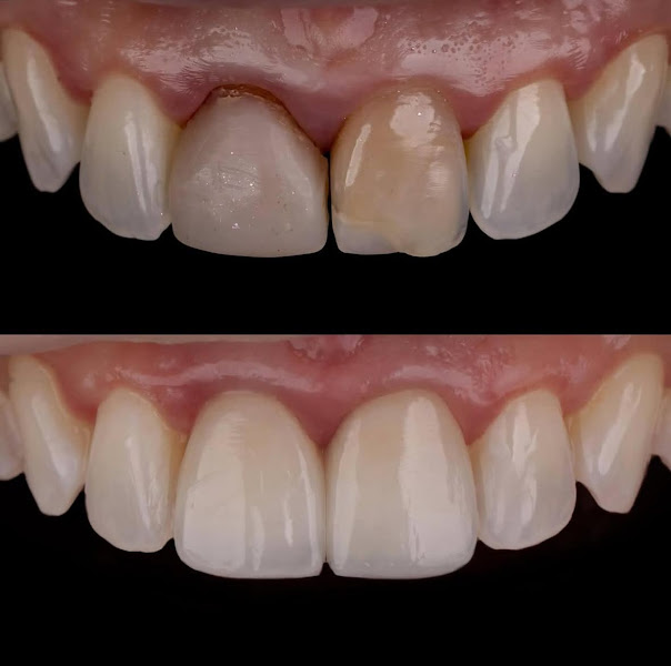 Foto 4 de Ortoestética Boa Viagem Sul | Facetas | Implantes | Ortodontia | Invisalign | Harmonização