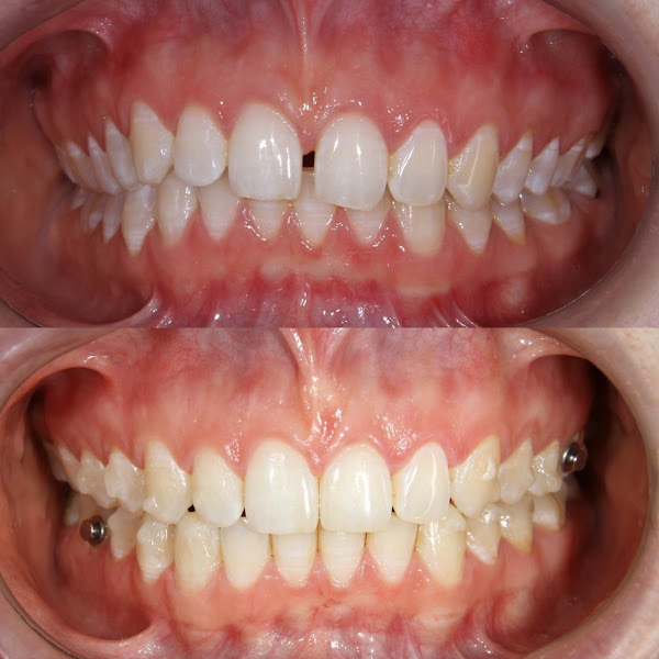 Foto 2 de Ortoestética Odontologia Invisalign