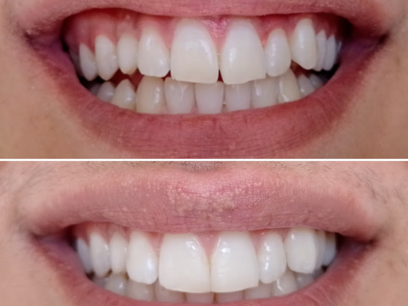 Foto 7 de Ortoestética Santa Efigênia: Harmonização Facial, Implantes e Clareamento Dental, Belo Horizonte - MG