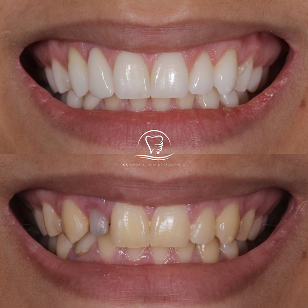 Foto 2 de OX Odontologia de Excelência | Lente de Contato | Implante | invisalign | Prótese | Protocolo | Dentista Campo Grande