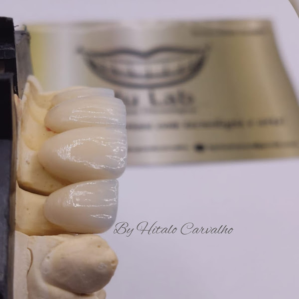 Foto 2 de PluLab - Laboratório de prótese especializado em lentes e facetas Dentais.