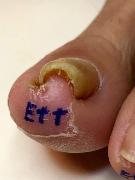 Foto 2 de Podologia Dra Jade UNHA ENCRAVADA NUNCA MAIS