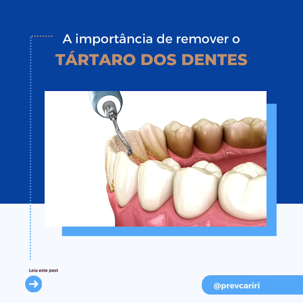 Foto 2 de PrevCariri clinica odontologica, implante dentário, Prótese, Facetas, Clareamento, Bucomaxilo, odontologia Geral.
