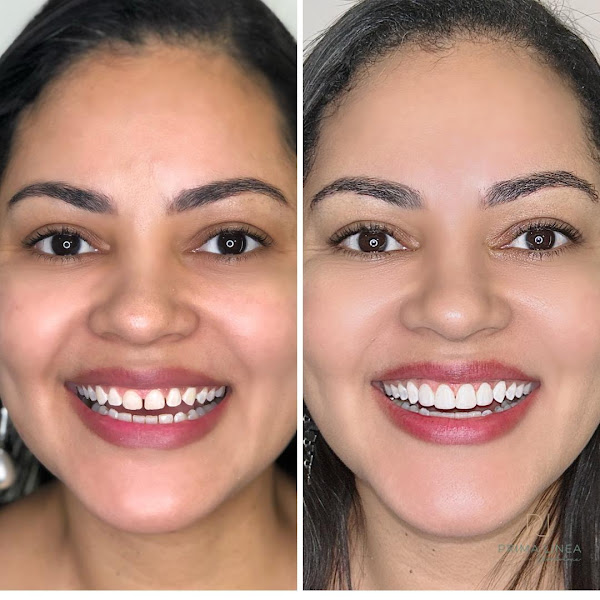 Foto 3 de Prima Linea Odontologia / Implantes / Invisalign