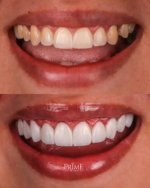 Foto 4 de Prime Lentes Dentais