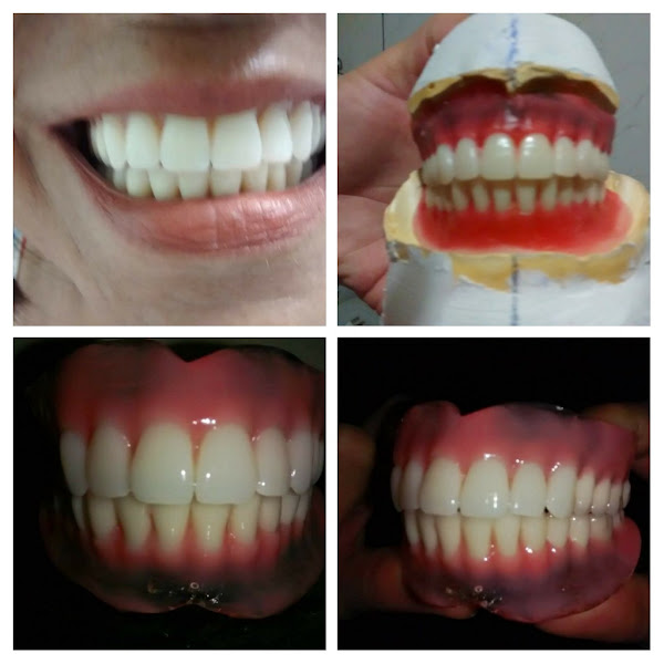 Foto 2 de Prótese dentária